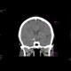 A tiny intracranial aneurysm on the branching ACA and ACM: CT - Computed tomography